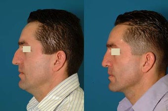 Male Rhinoplasty before 117305