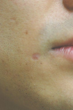 Laser Scar Removal Los Angeles before 145654