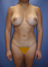 Liposuction and Breast Augmentation after 96767