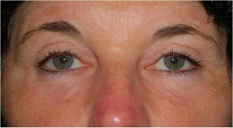 upper and lower Laser Blepharoplasty-Eyelid Surgery after 341305