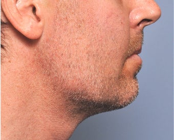 Jawline Augmentation 524379