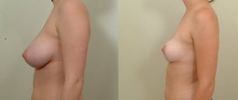 Breast Reduction after 106762