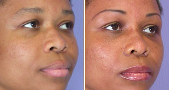Nose reshaping before 271204