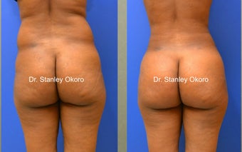 Brazilian Buttock Lift before 567088
