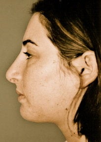 Rhinoplasty after 278373