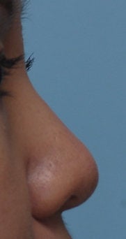 Non Surgical Rhinoplasty after 328327