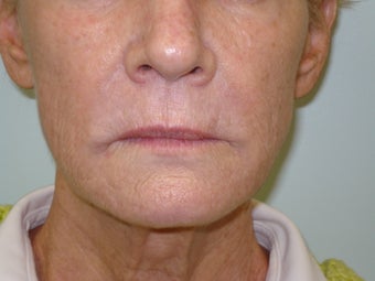 Facelift In A Syringe after 577237