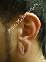 Earlobe Repair Surgery 612296