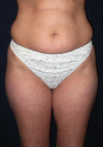 Tummy Liposuction before 229699