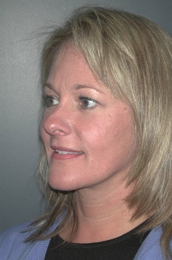 Facelift after 137854