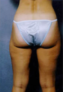 Suction Lipectormy of Inner and Outer thighs 427988