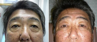 Cosmetic eyelid surgery before 128408