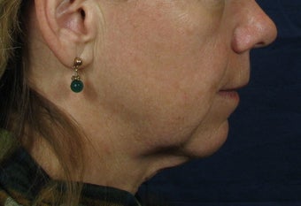 Laser Facelift before 249016