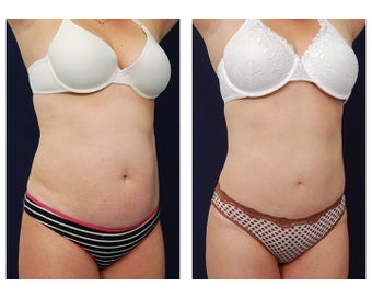 Liposuction after 391783