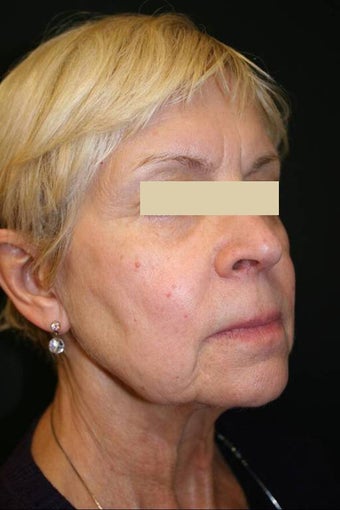 Sculptra before 137051