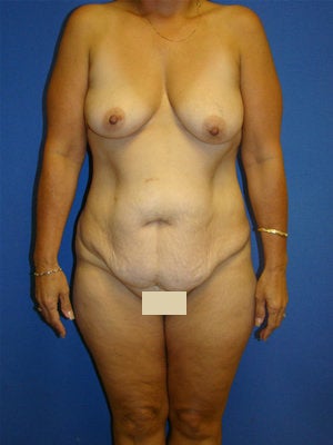 Extended Tummy Tuck, Breast Lift with Implants before 154505