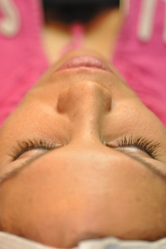 Chemical Peel after 607354