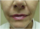 juvederm before 267545