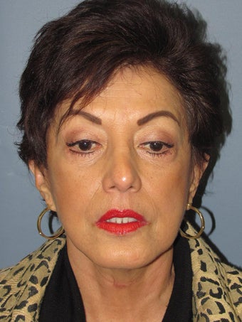 Neck Lift, Platysmaplasty after 634750