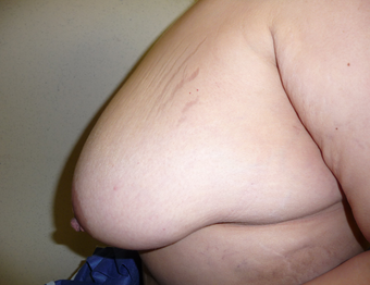 Breast reduction using the Ultimate Lift technique 360387