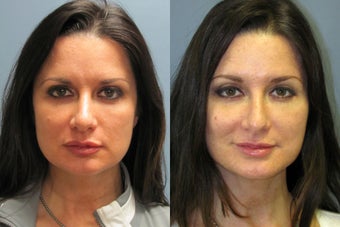 Lite Lift, Brow Lift after 523333