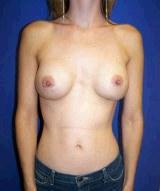 Breast Revision Surgery with Silicone-Gel Implants before 149051