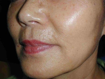 Sculptra after 108826