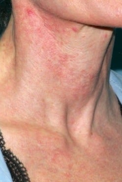 Vbeam laser treatment 374531