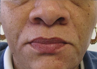Restylane Injection Nasolabila folds after 387849