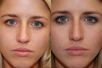 Silikon-1000 to Lower Eyelid Grooves, and Laugh Lines before 123679