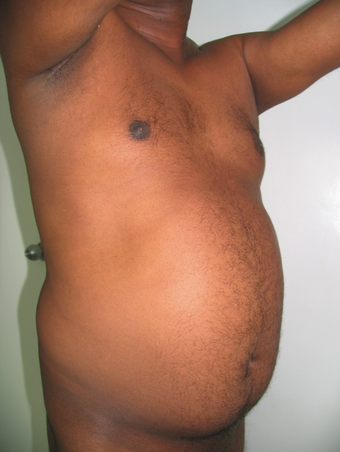 Tummy Liposuction before 229658