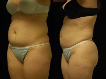 Smartlipo MPX abdomen, waist and flanks before 413234