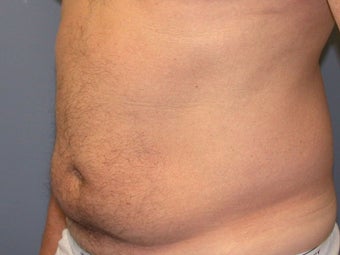 Liposuction 581438