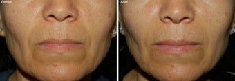 Fillers for Nasolabial Folds before 97881