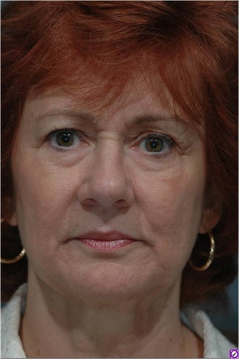 Upper and Lower Blepharoplasty or Eyelid Lift, Eye Bags treatment before 292969