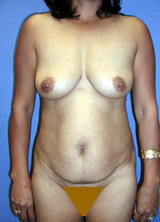 Tummy Tuck Surgery (Adominoplasty) and Augmentation before 122962