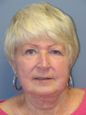 Neck Lift, Platysmaplasty after 634731