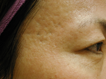 Acne Scars before 200602