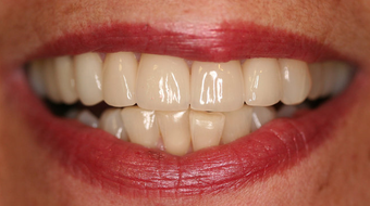 Full Porcelain Crowns after 145684