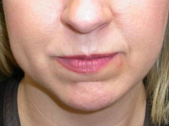Fillers before 148701