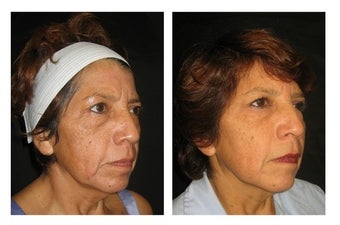 Non-Surgicial Facelift after 610411
