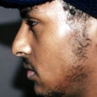 African American Rhinoplasty before 448652