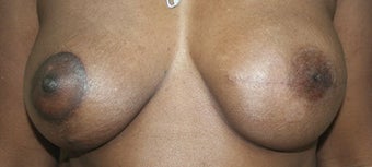 Breast Reconstruction after 517492