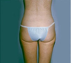 Smartlipo 401656