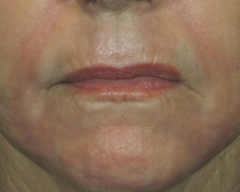 Ridding Lip Lines & Wrinkles with C02 Laser after 628481