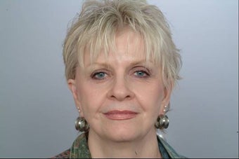 Juvederm Injection before 337260
