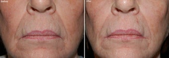 Juvederm before 97776