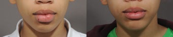 Lip Reduction before 323956