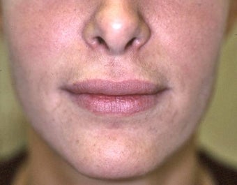 Lip Augmentation with Liquid Injectable Silicone after 157589