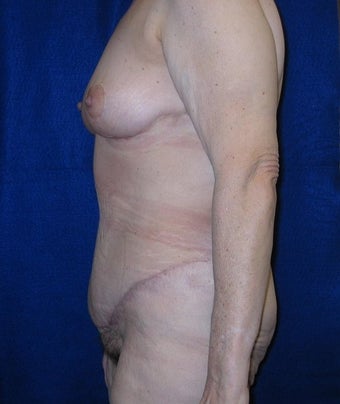 Body Lift and Breast Lift 400450